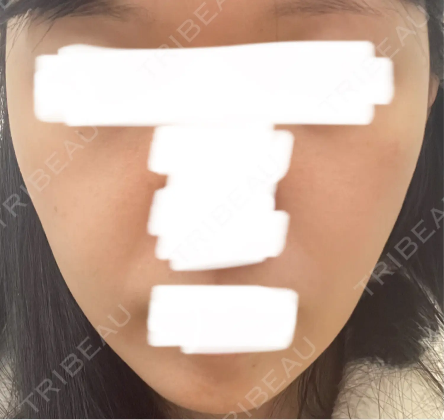 施術前の写真