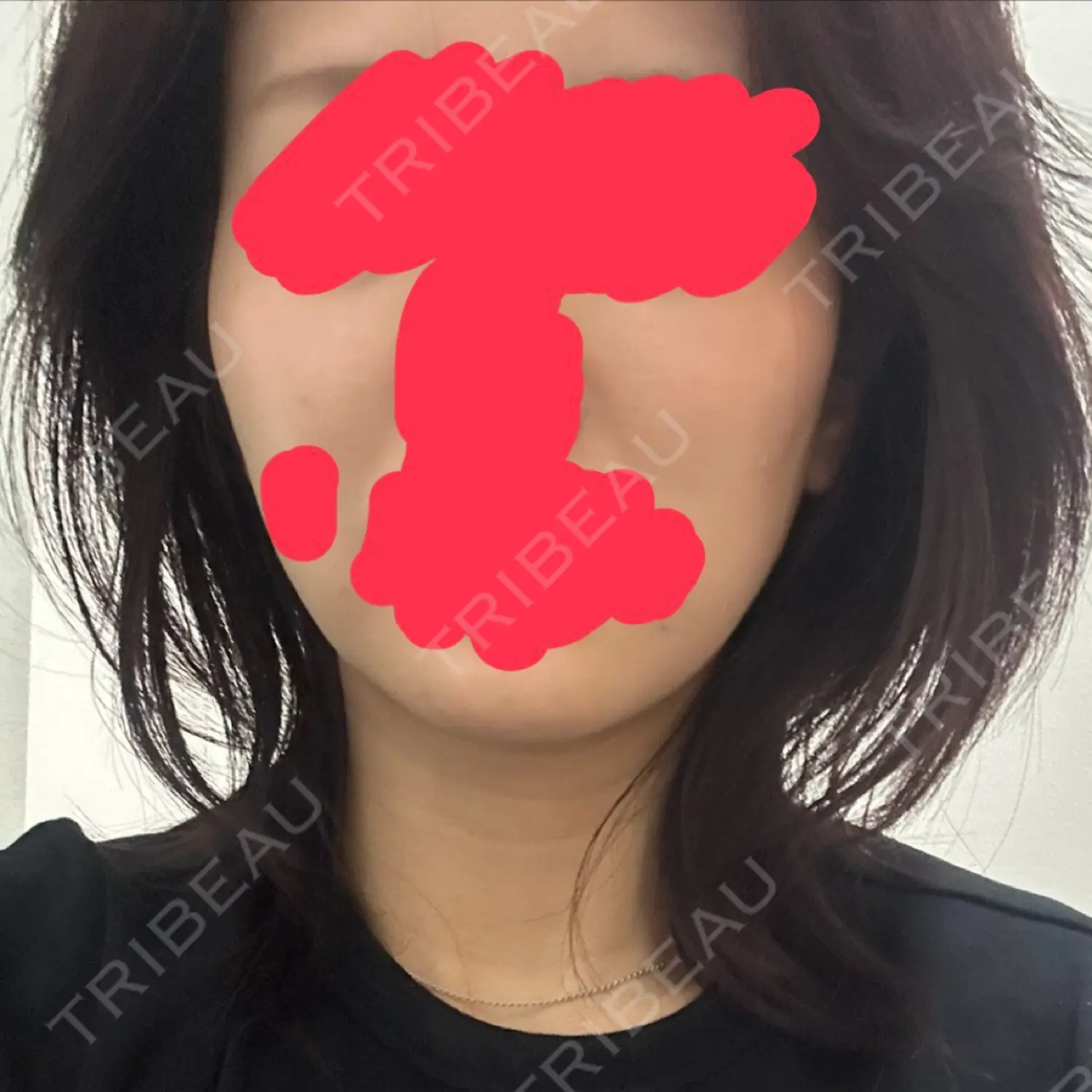 施術前の写真