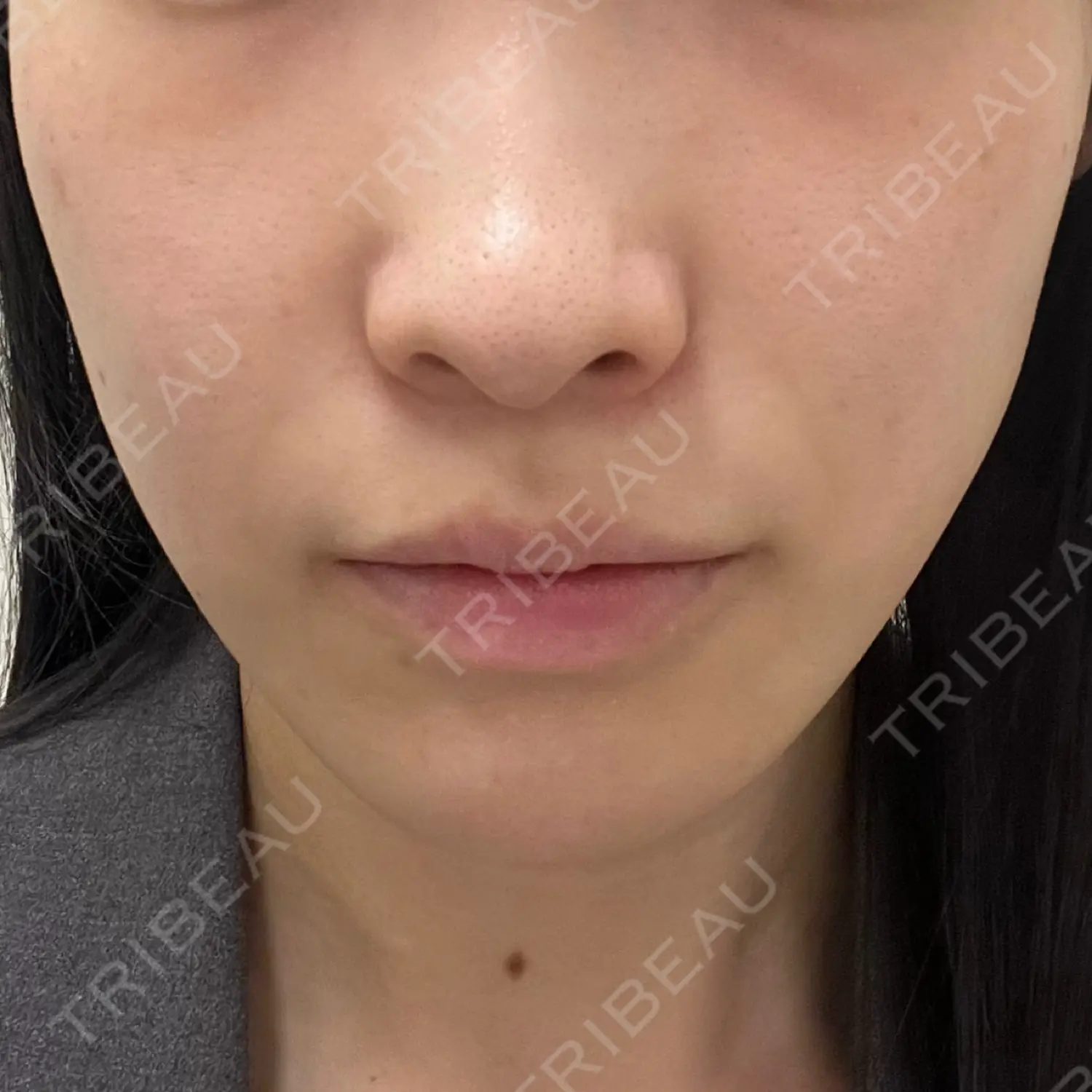 施術前の写真