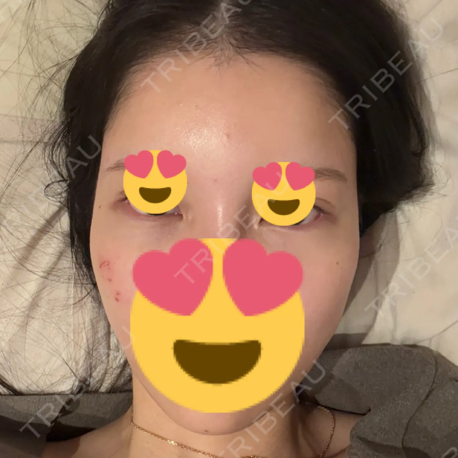 施術前の写真