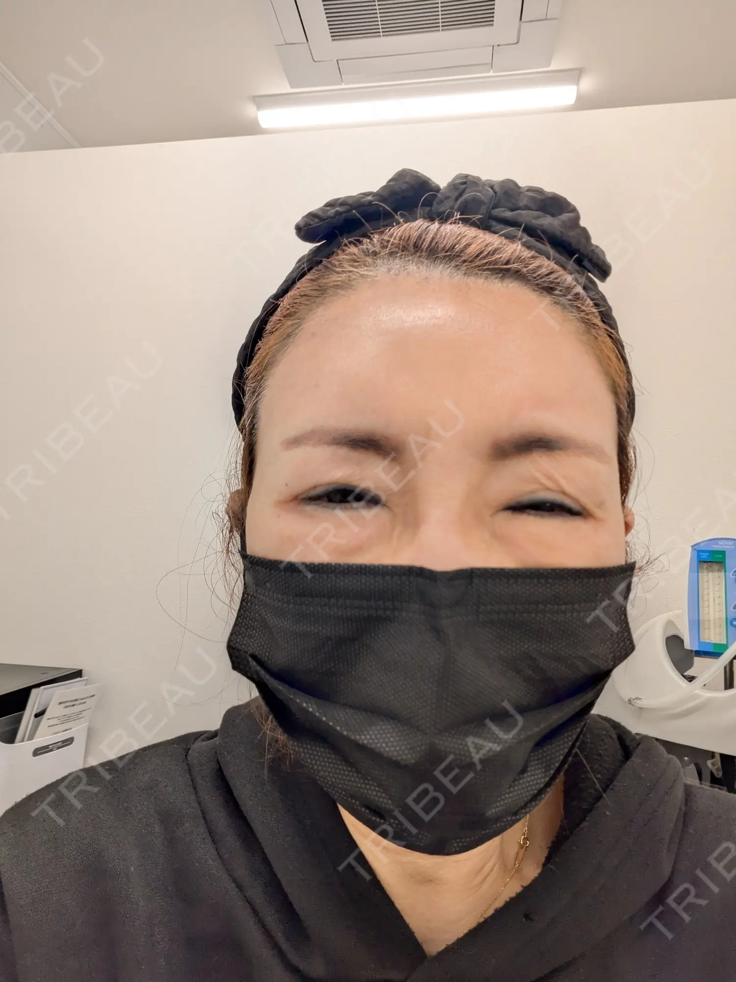 施術前の写真