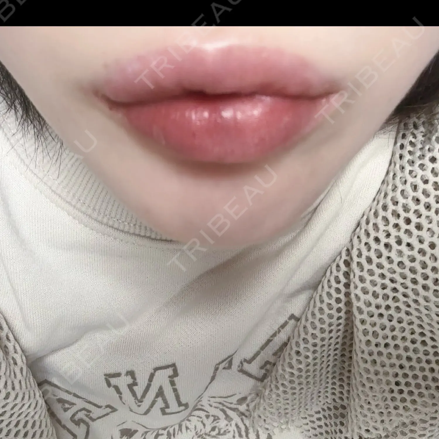 施術前の写真