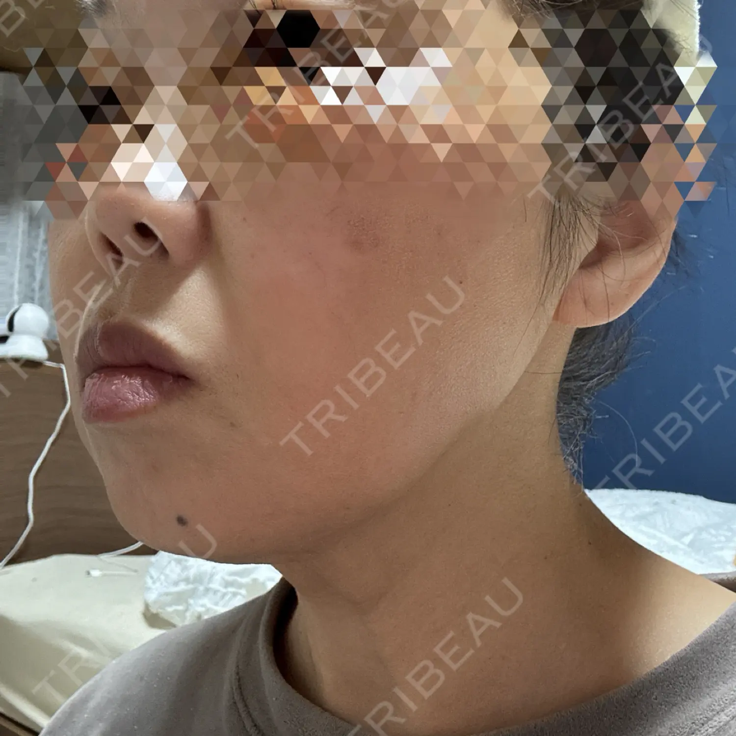 施術前の写真