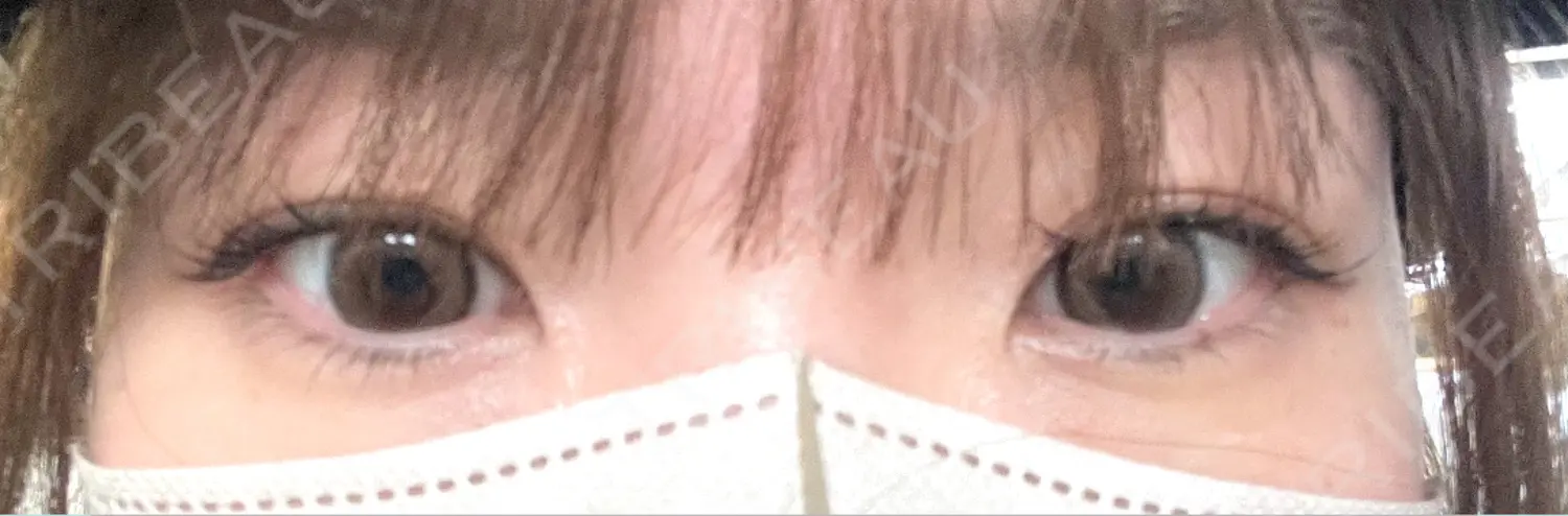 施術前の写真