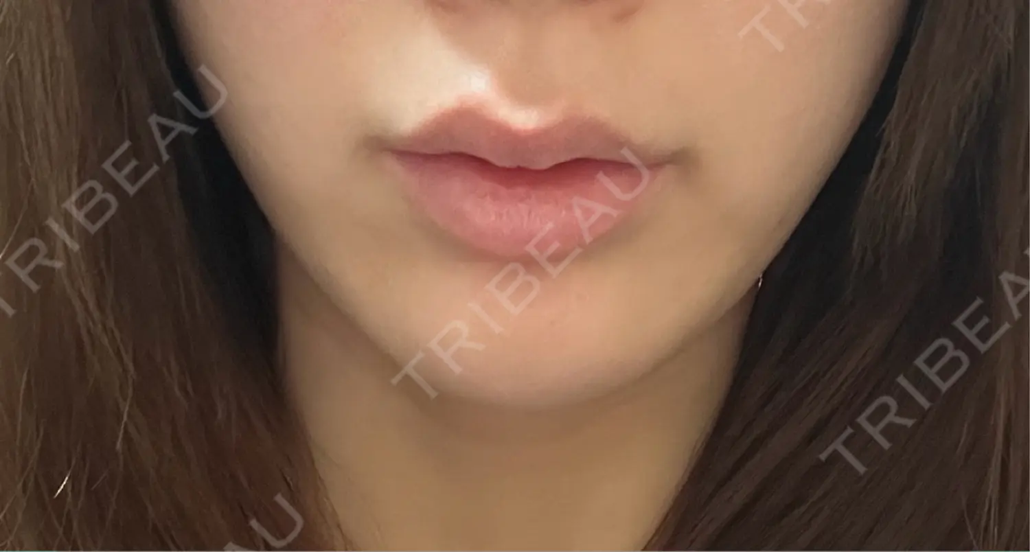 施術前の写真