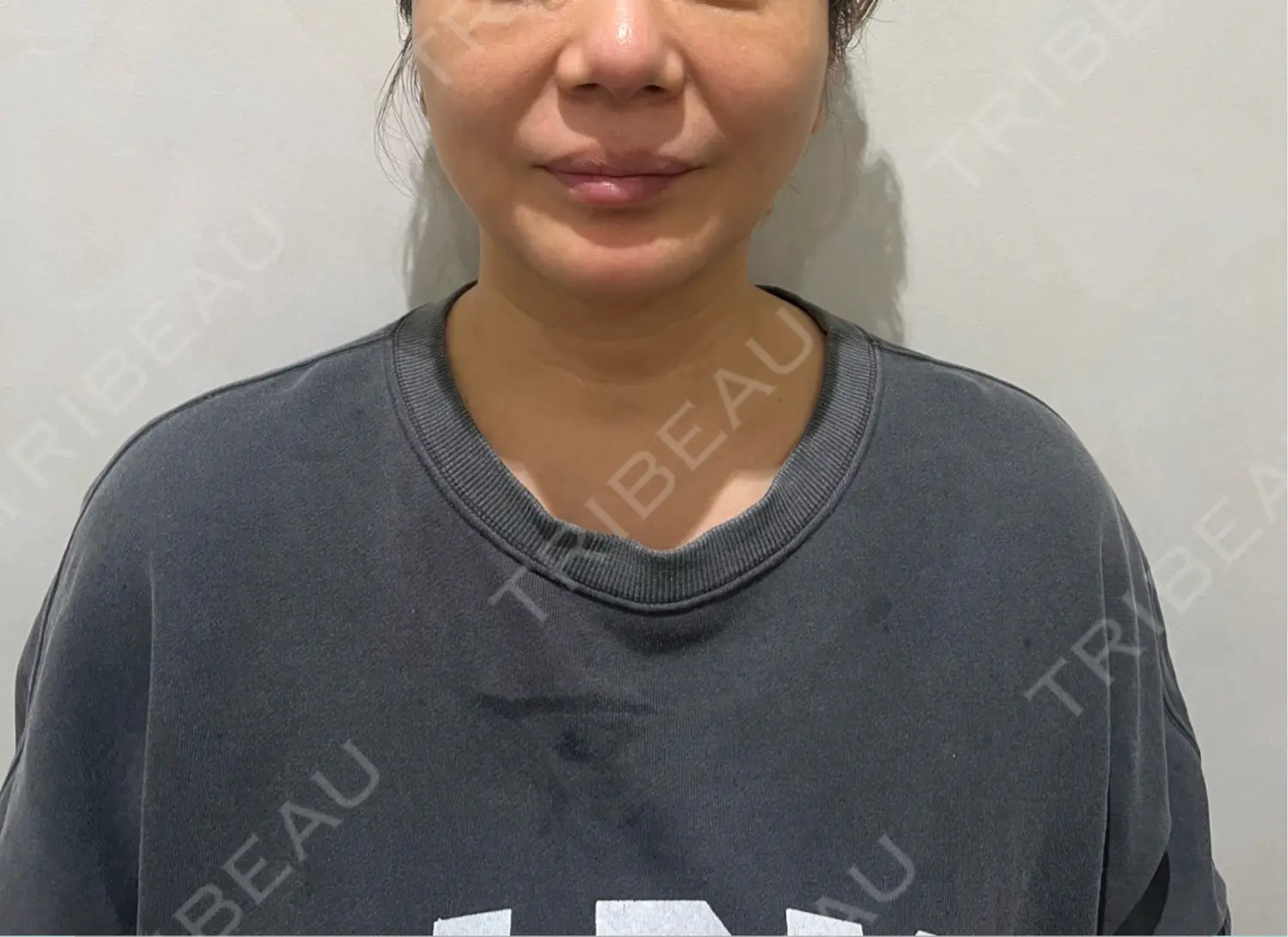 施術前の写真