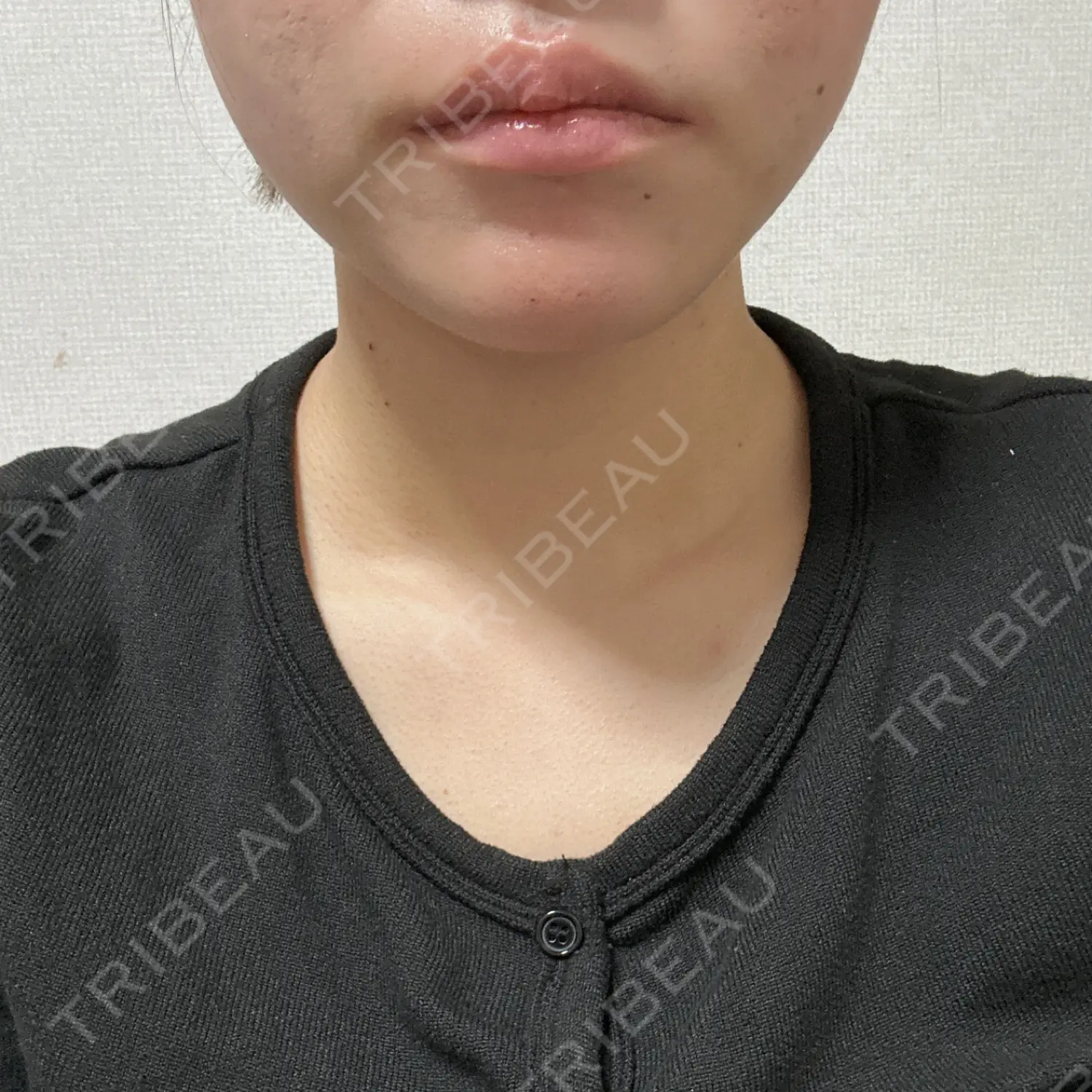 施術前の写真