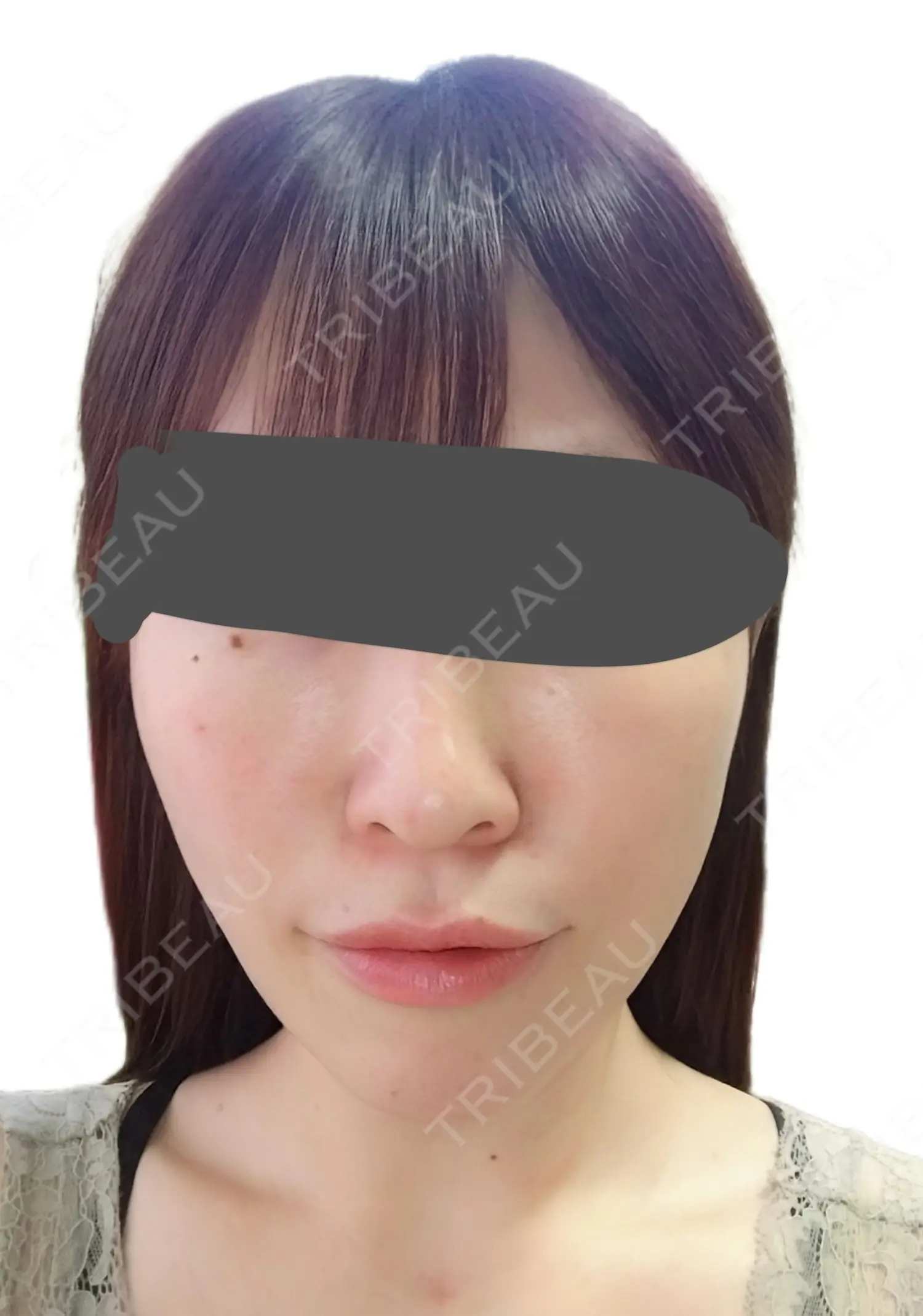 施術前の写真