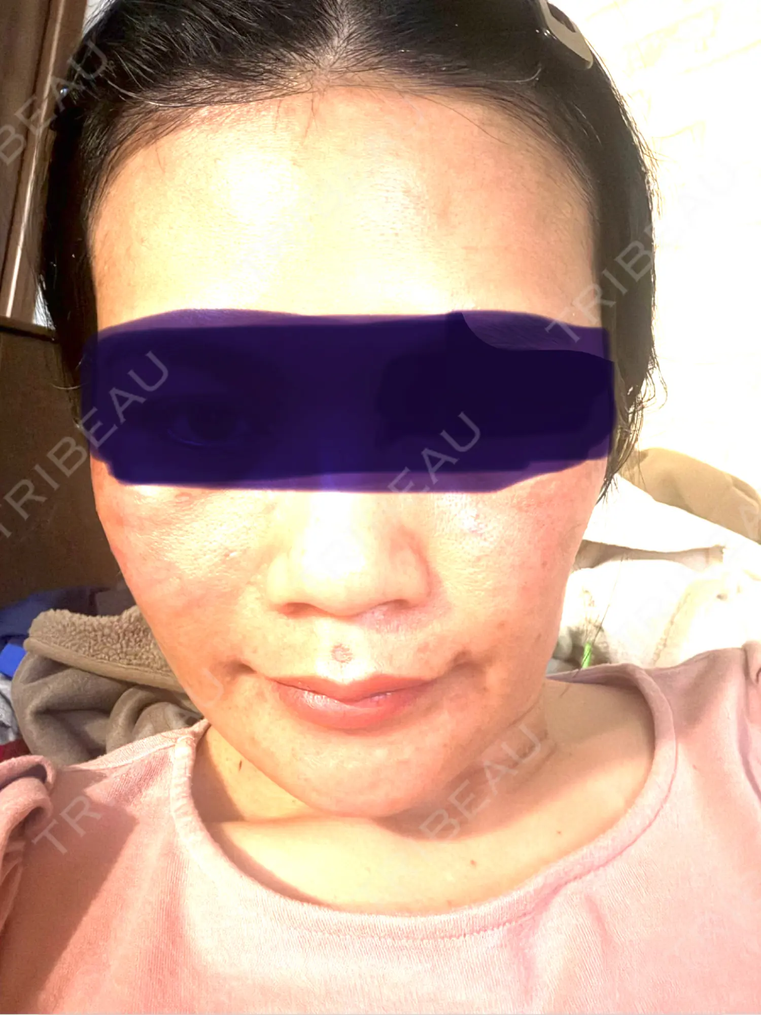 施術前の写真