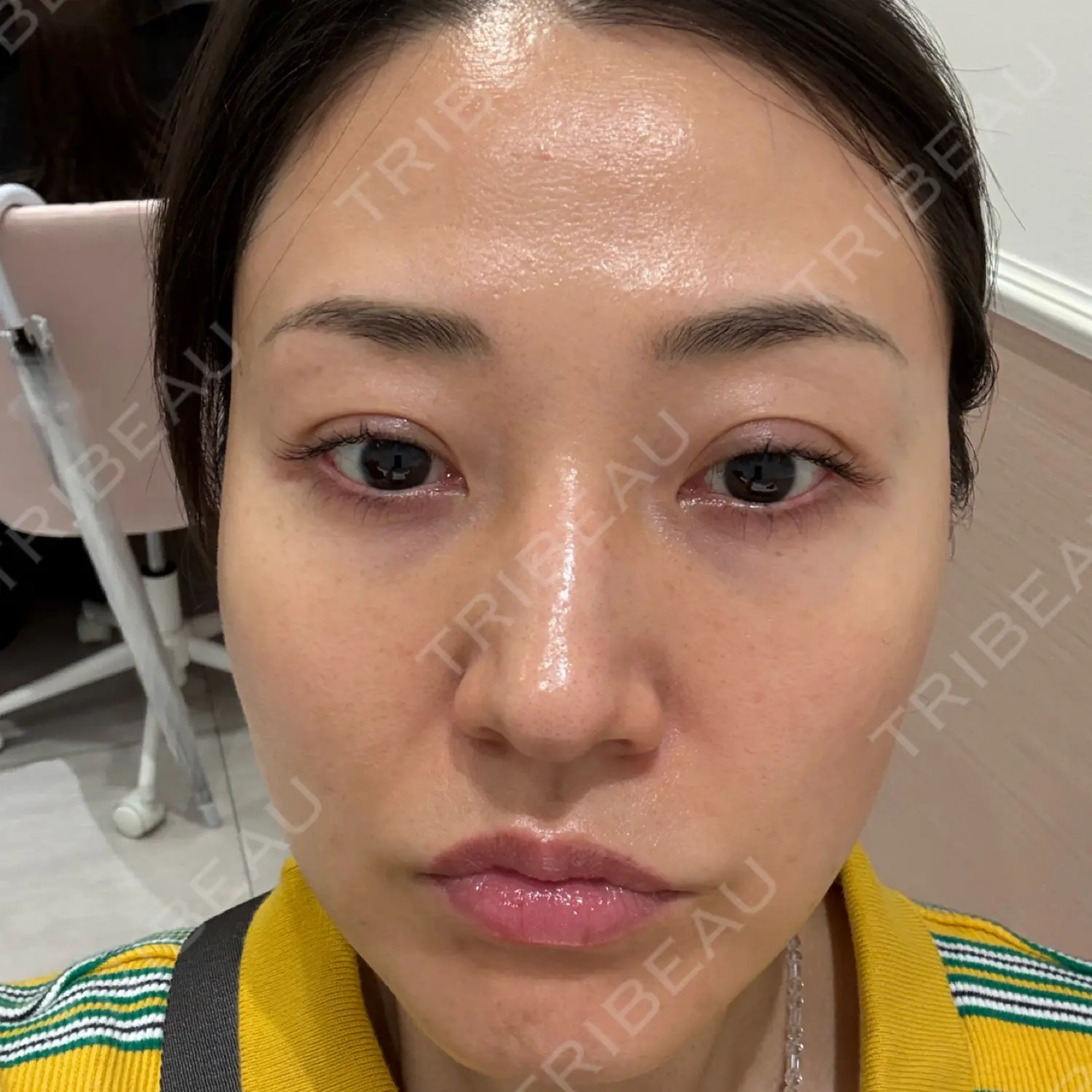 施術前の写真