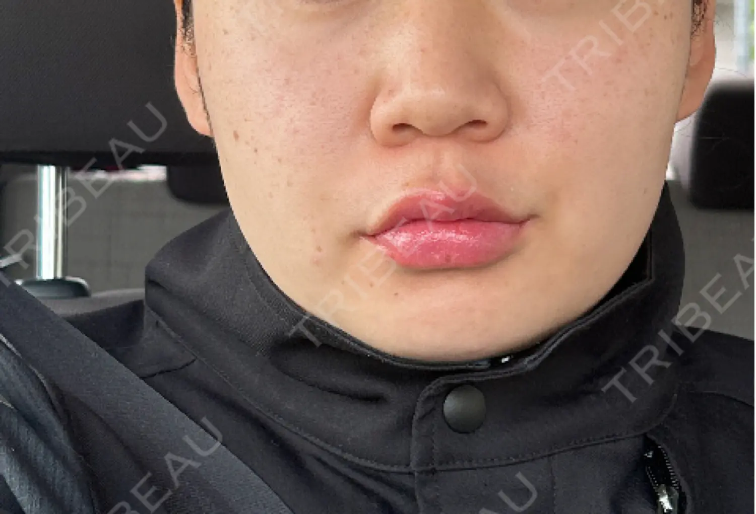 施術前の写真