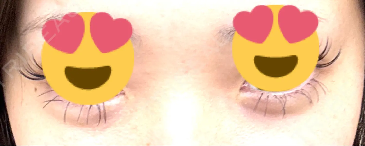 施術前の写真