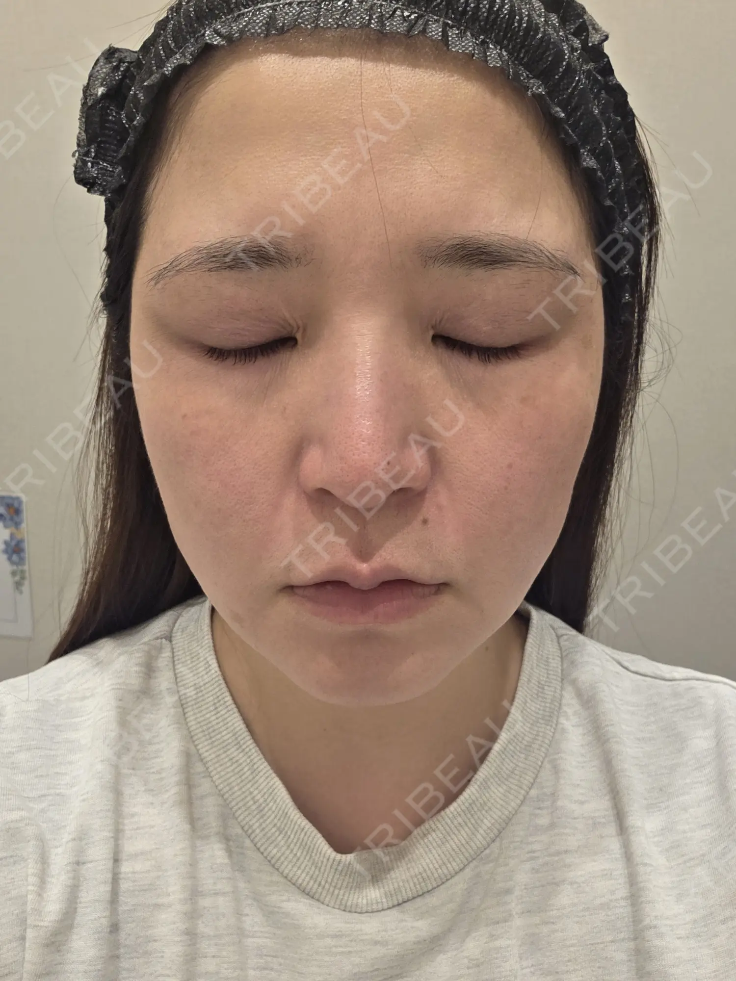 施術前の写真