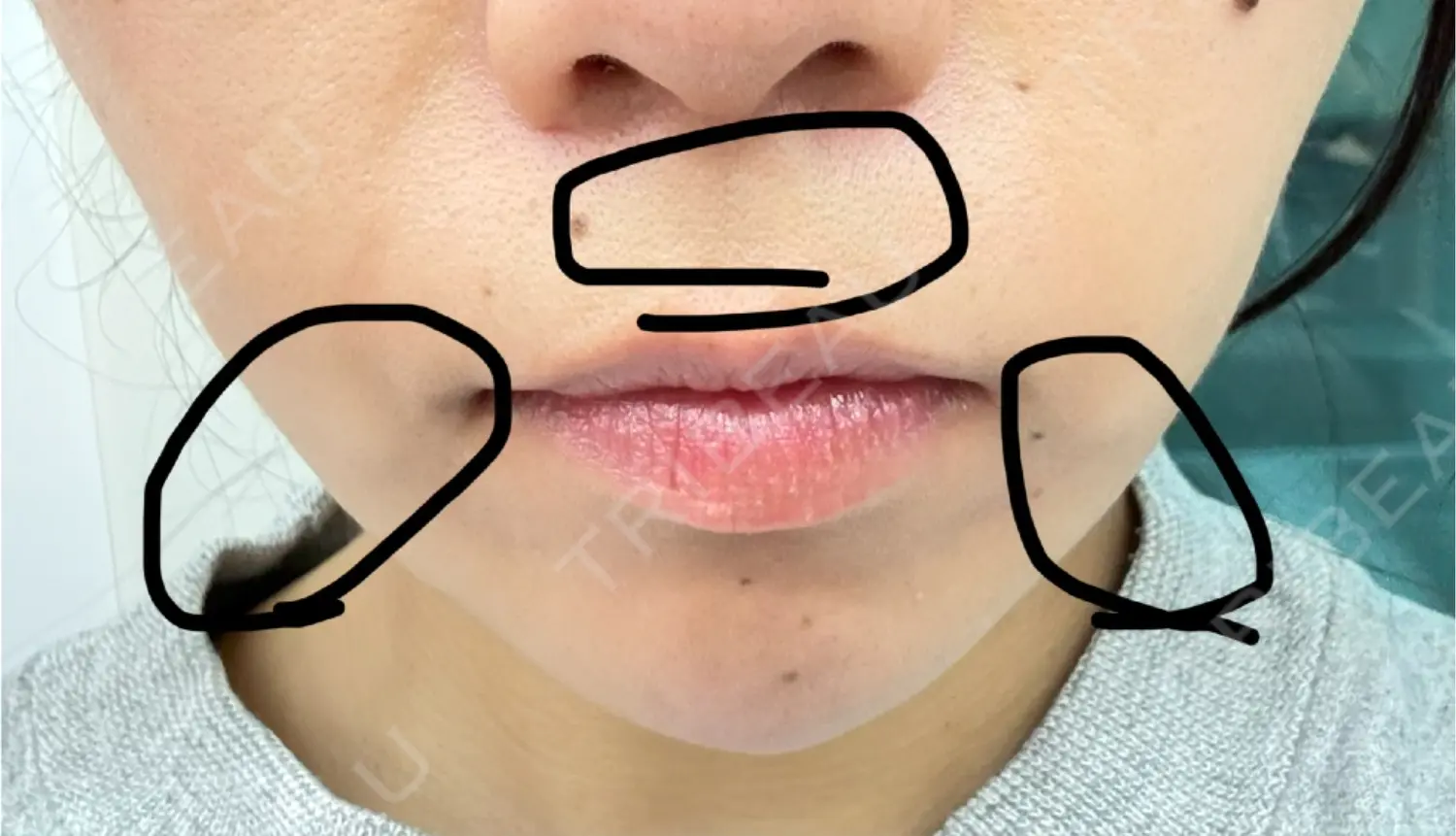 施術前の写真