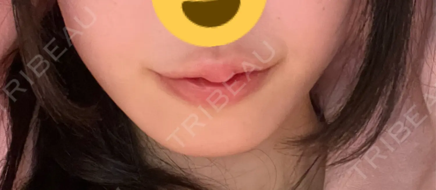 施術前の写真