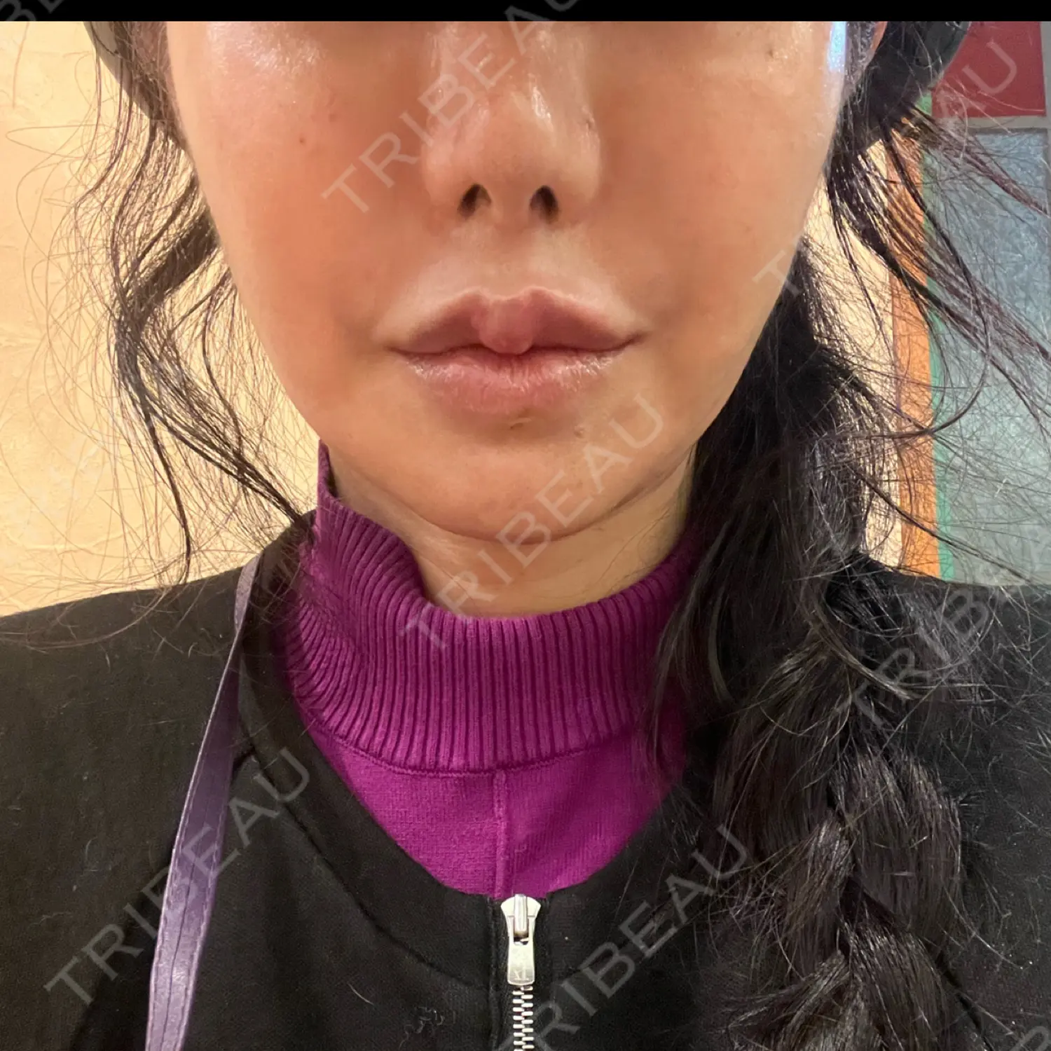 施術前の写真