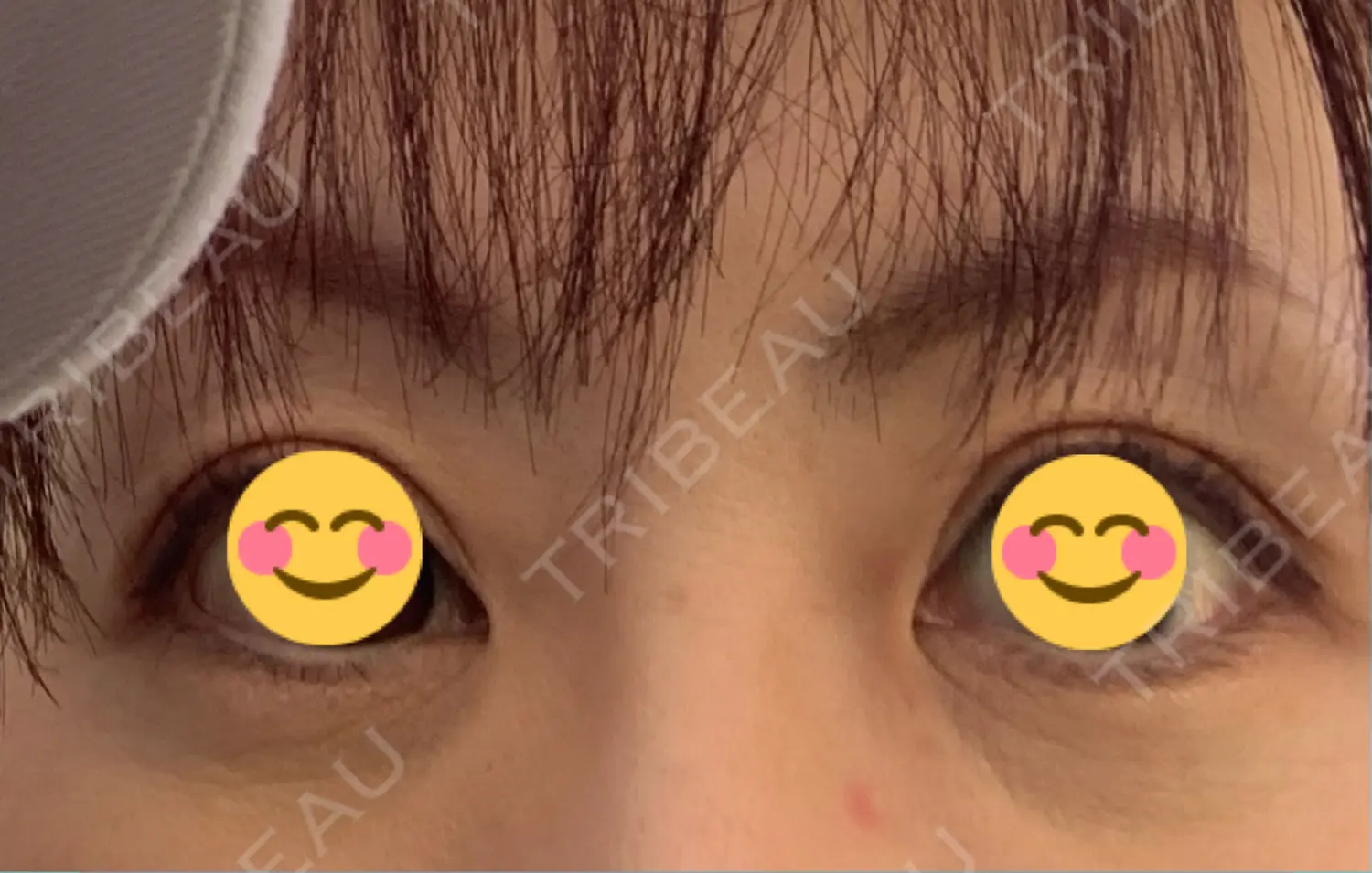 施術前の写真