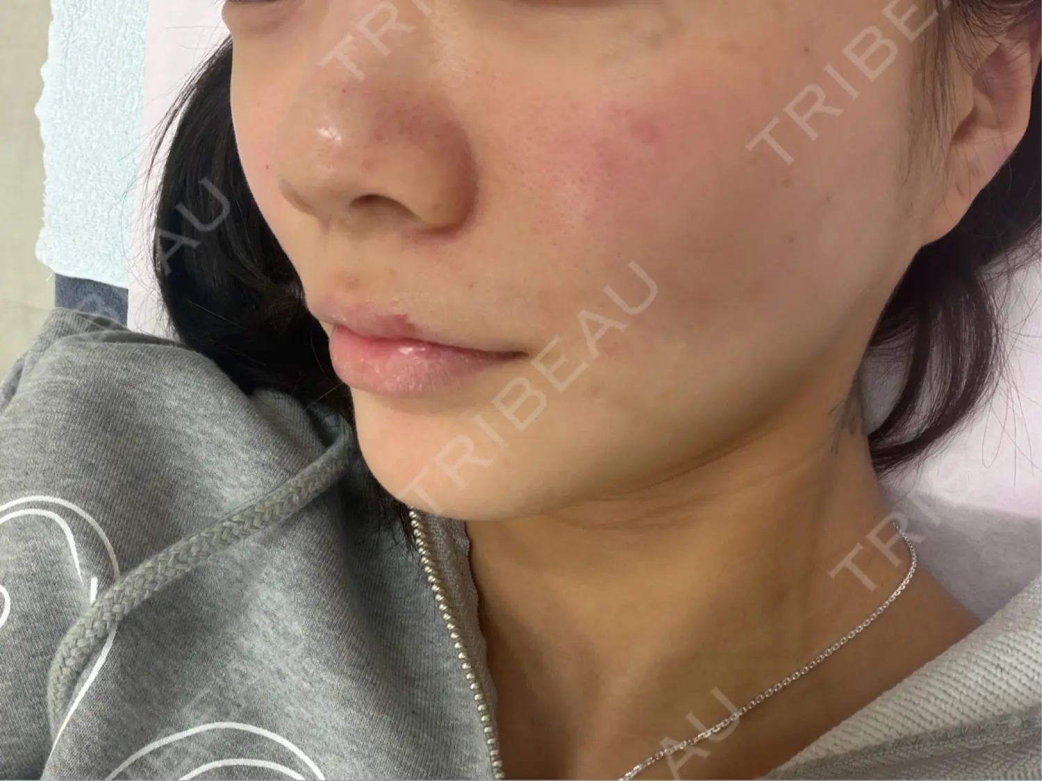 施術前の写真