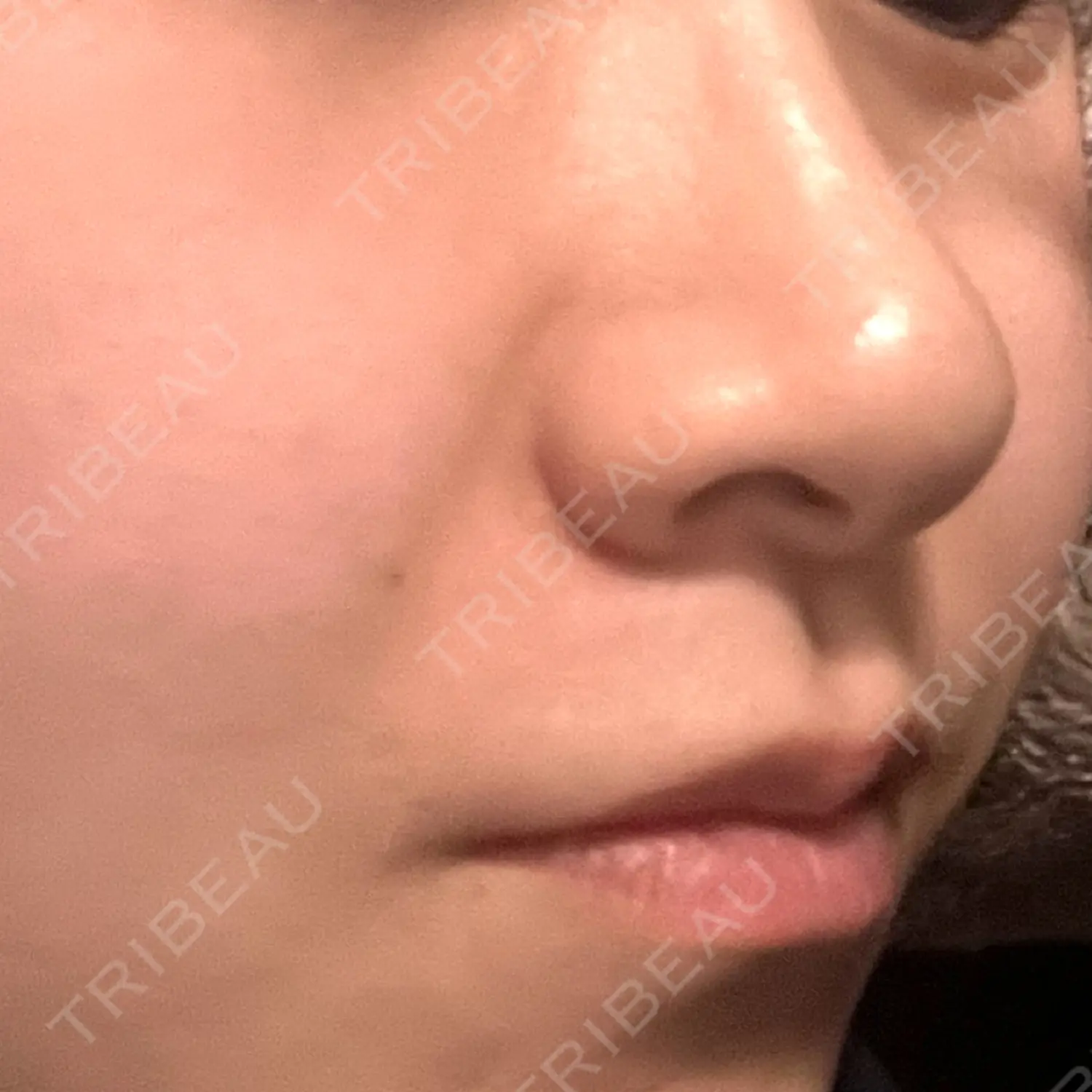 施術前の写真