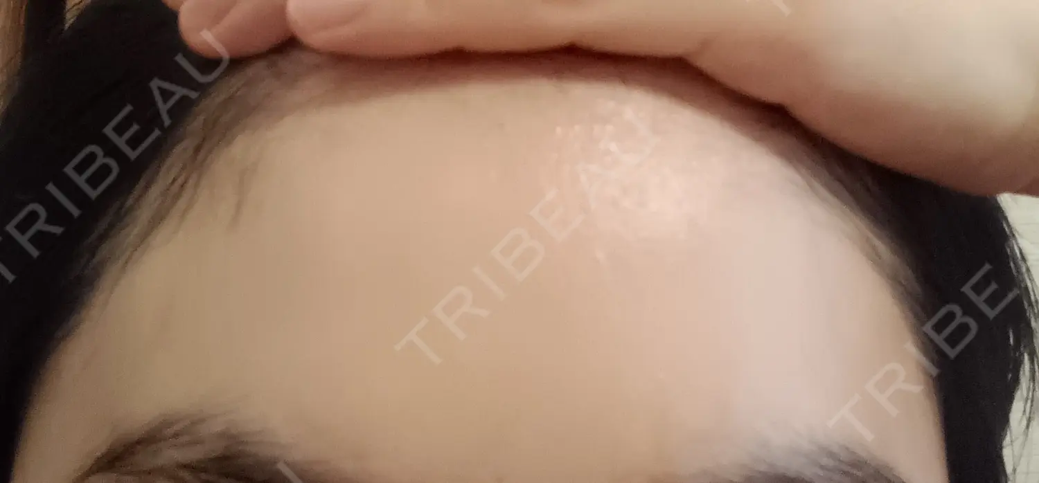 施術前の写真