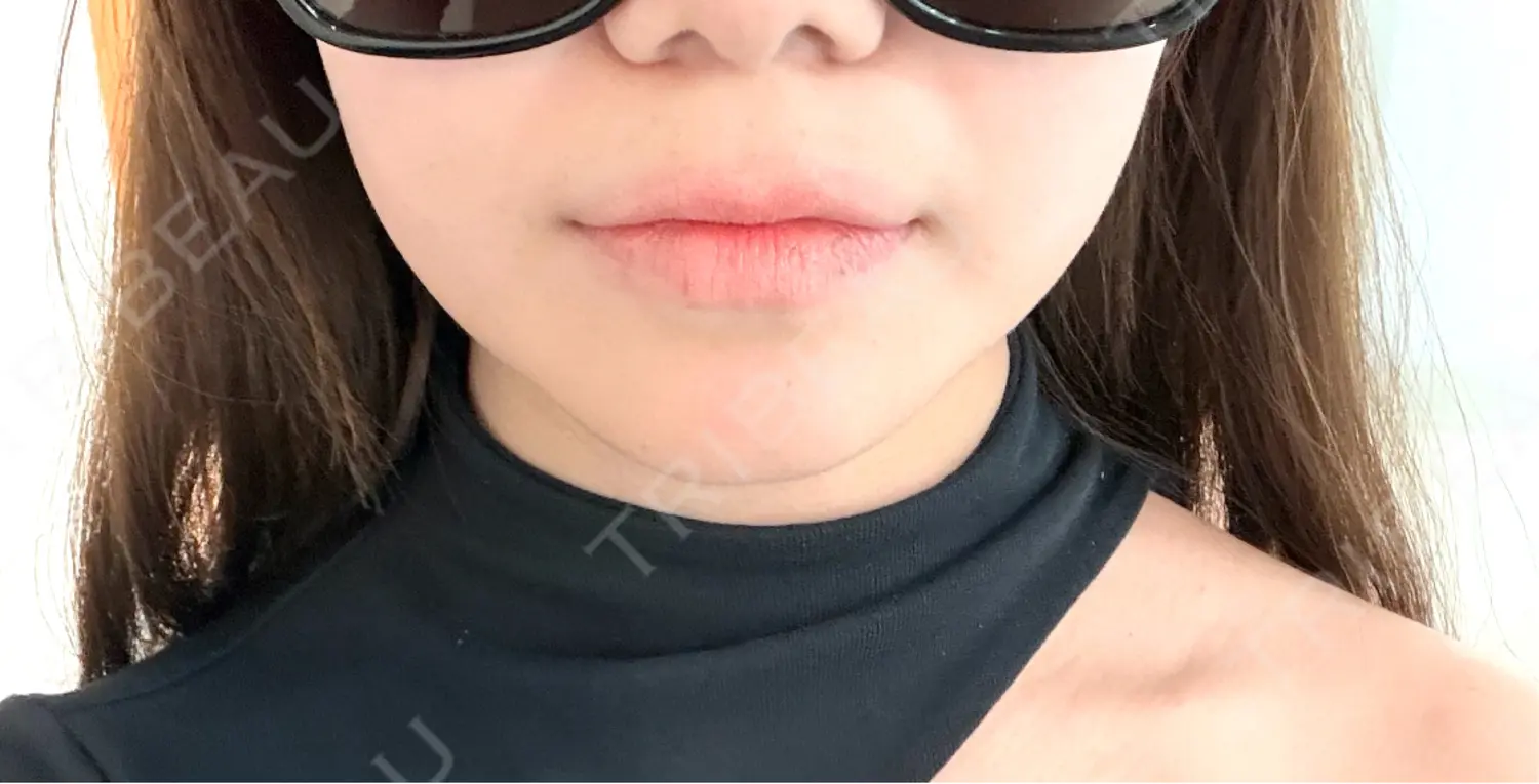 施術前の写真