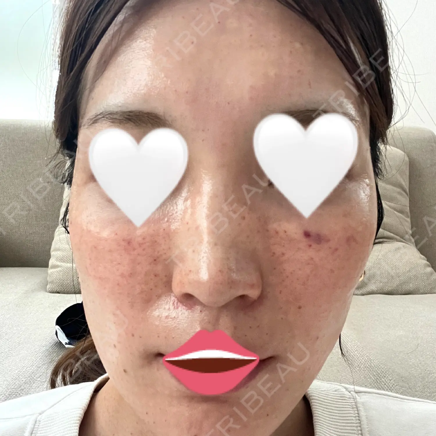 施術前の写真