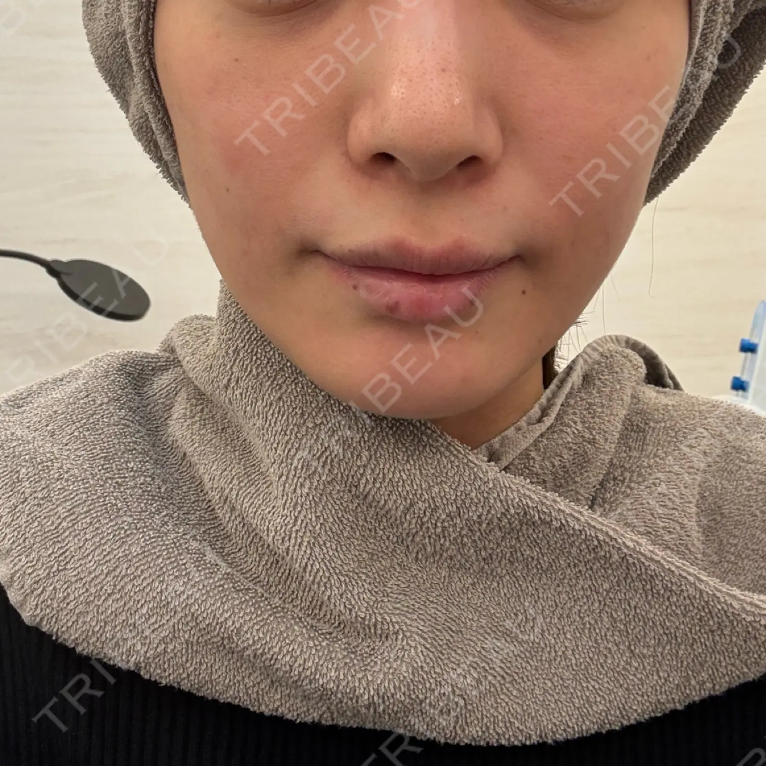 施術前の写真