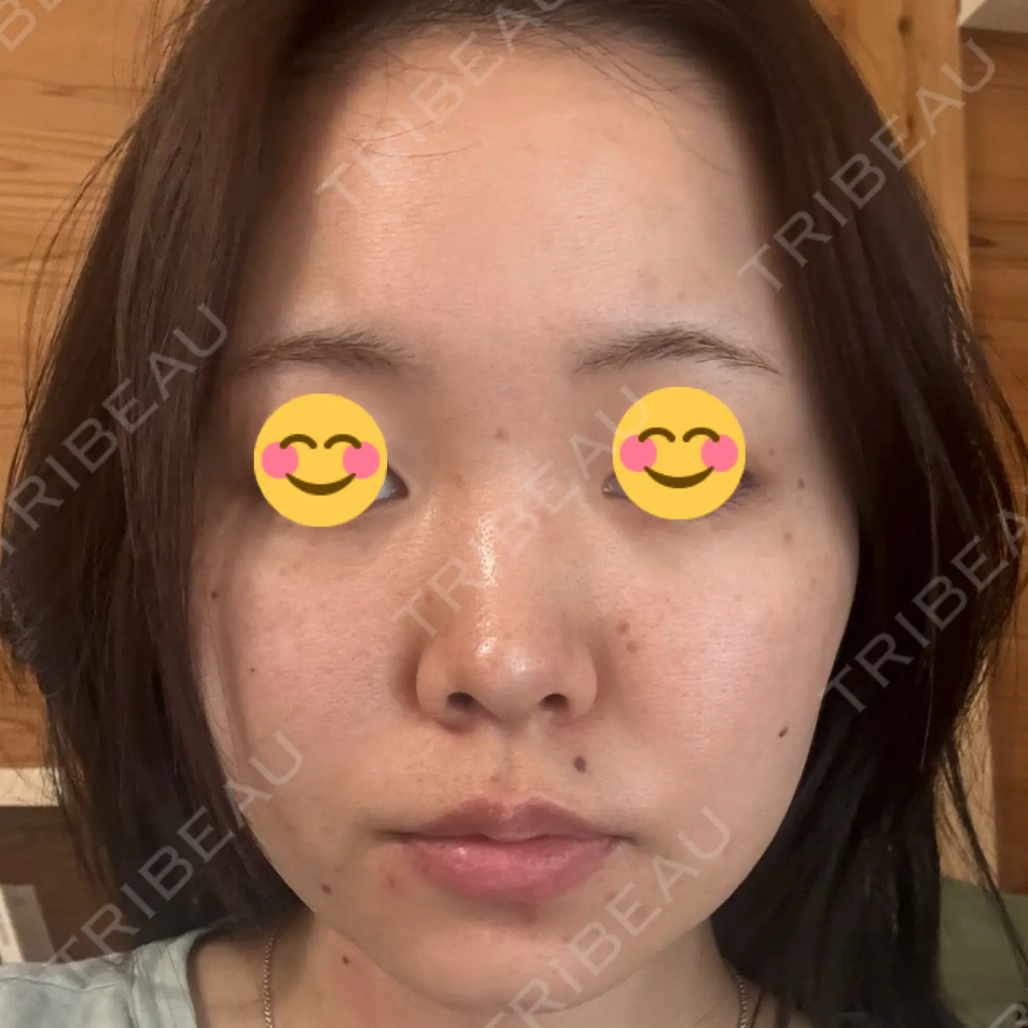 施術前の写真