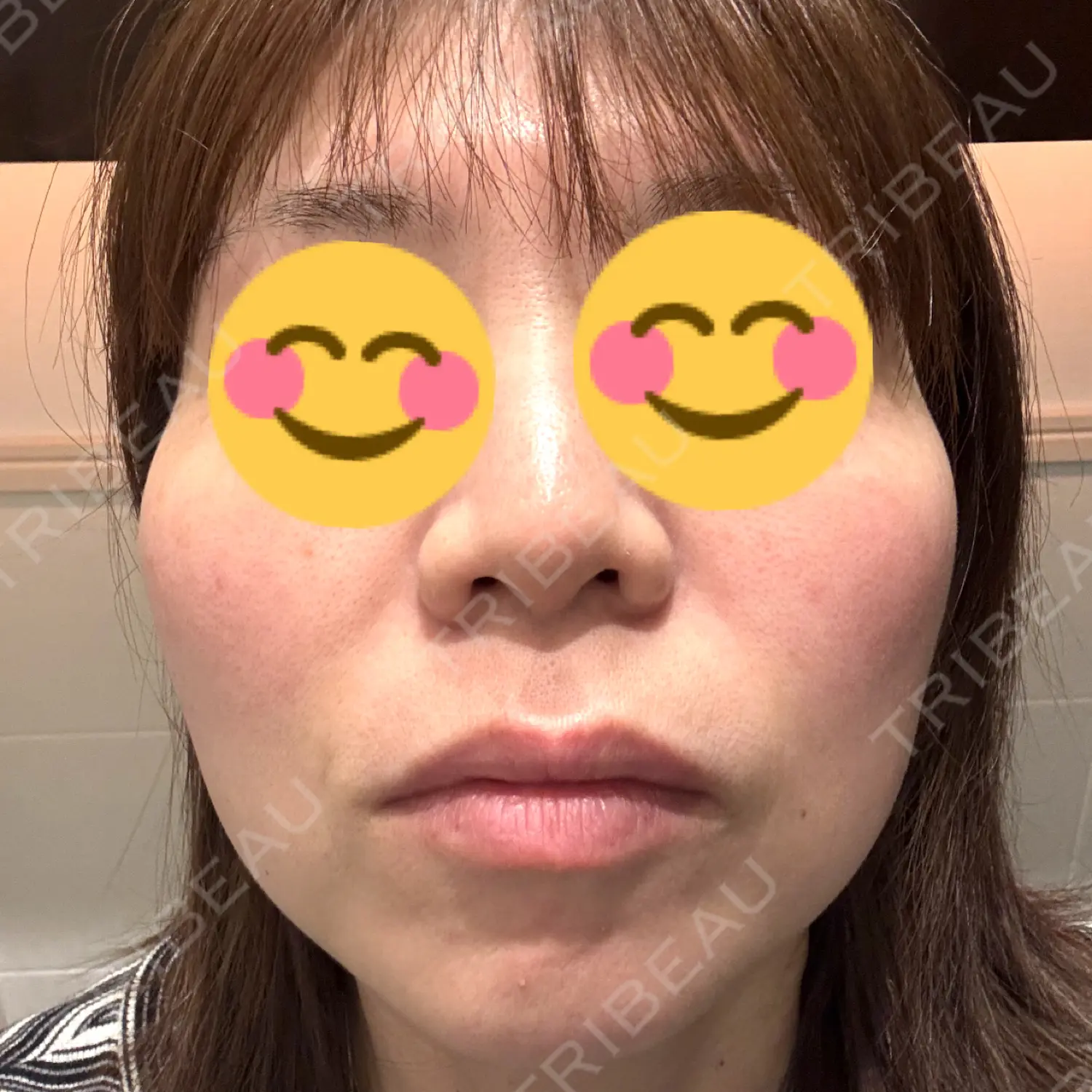 施術前の写真