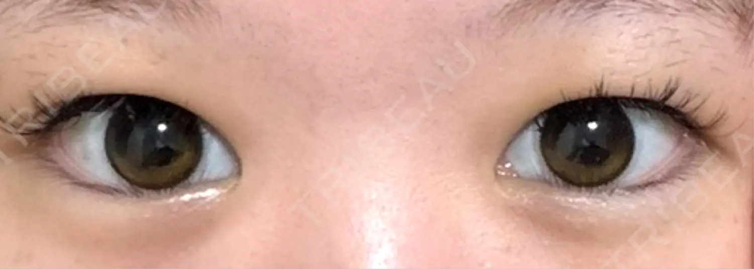 施術前の写真