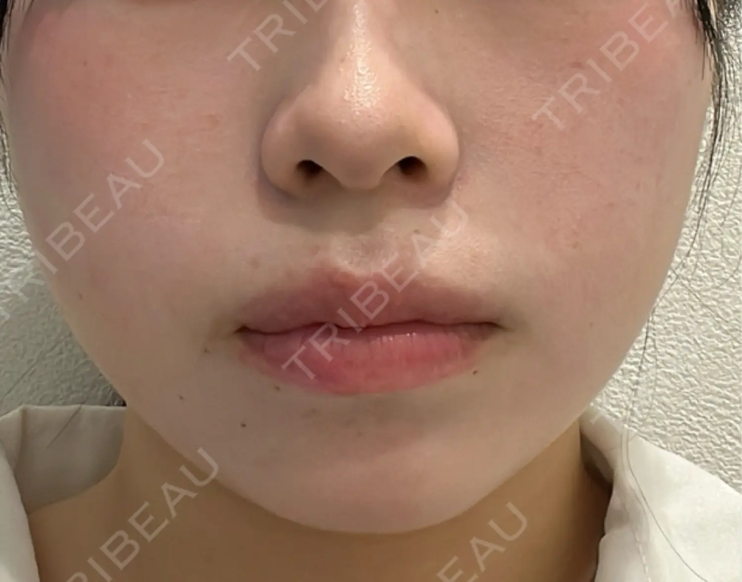 施術前の写真