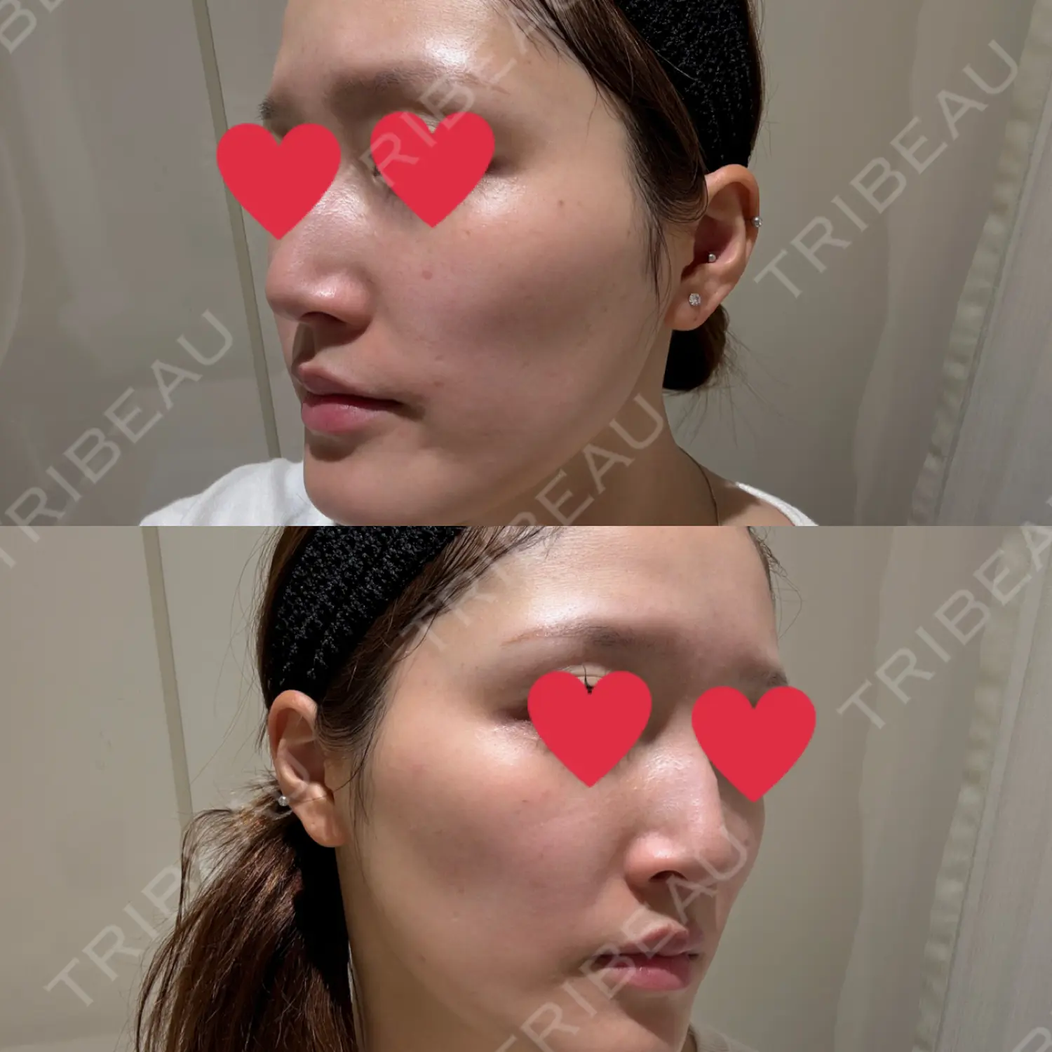 施術前の写真