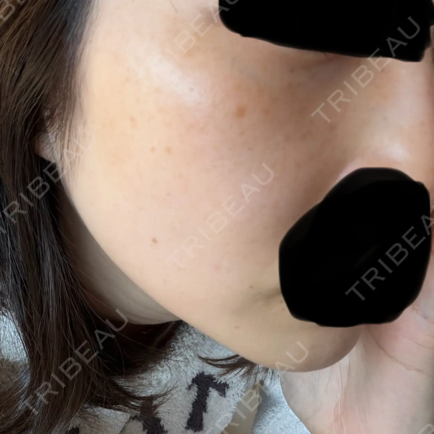 施術前の写真