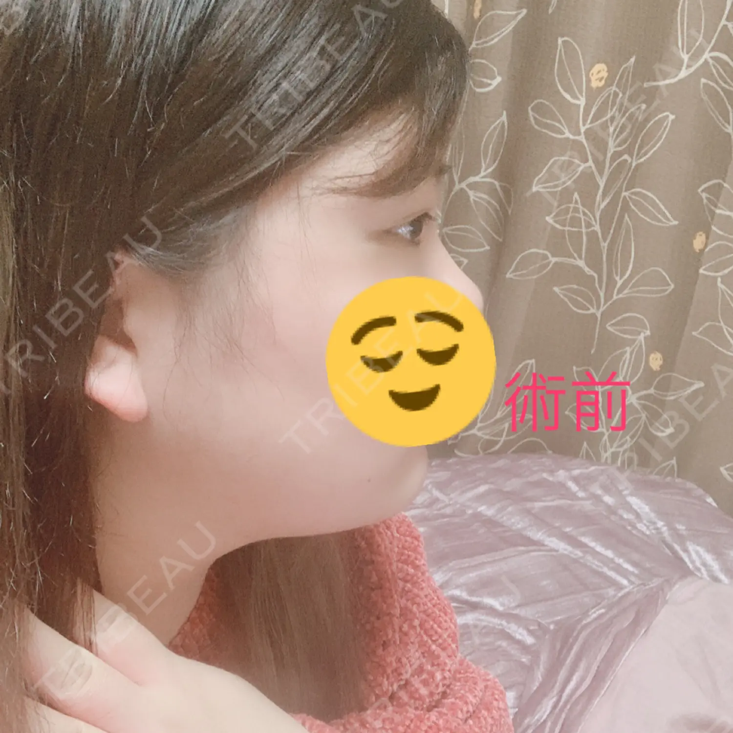 施術前の写真