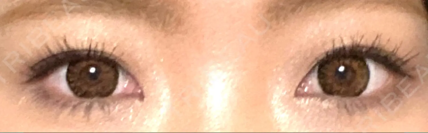 施術前の写真