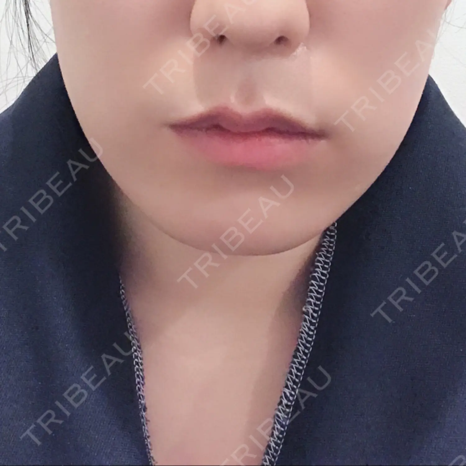 施術前の写真