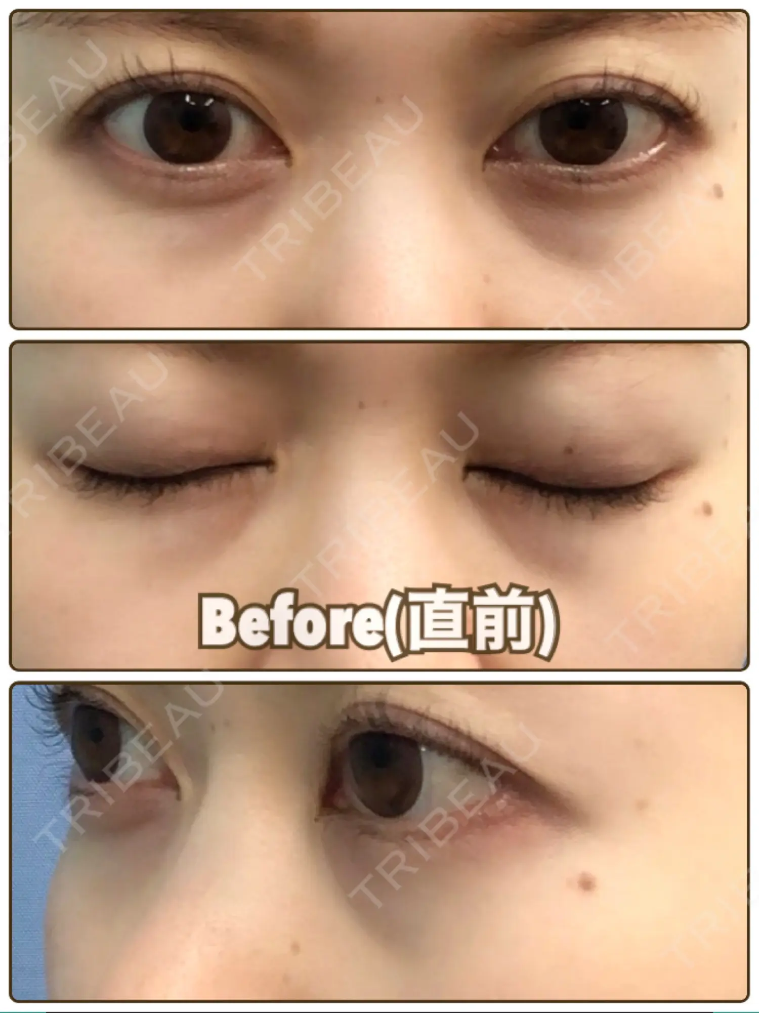 施術前の写真