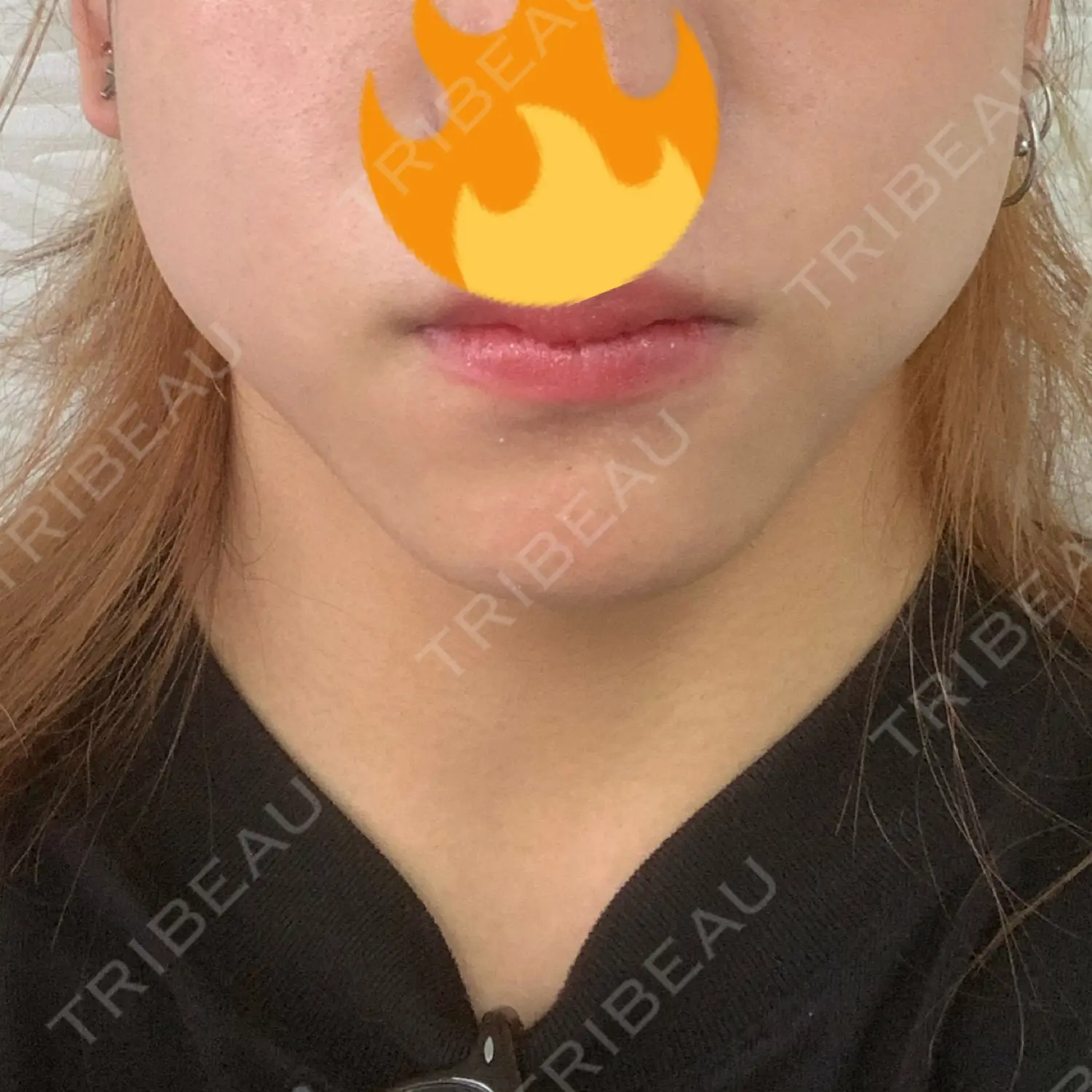 施術前の写真