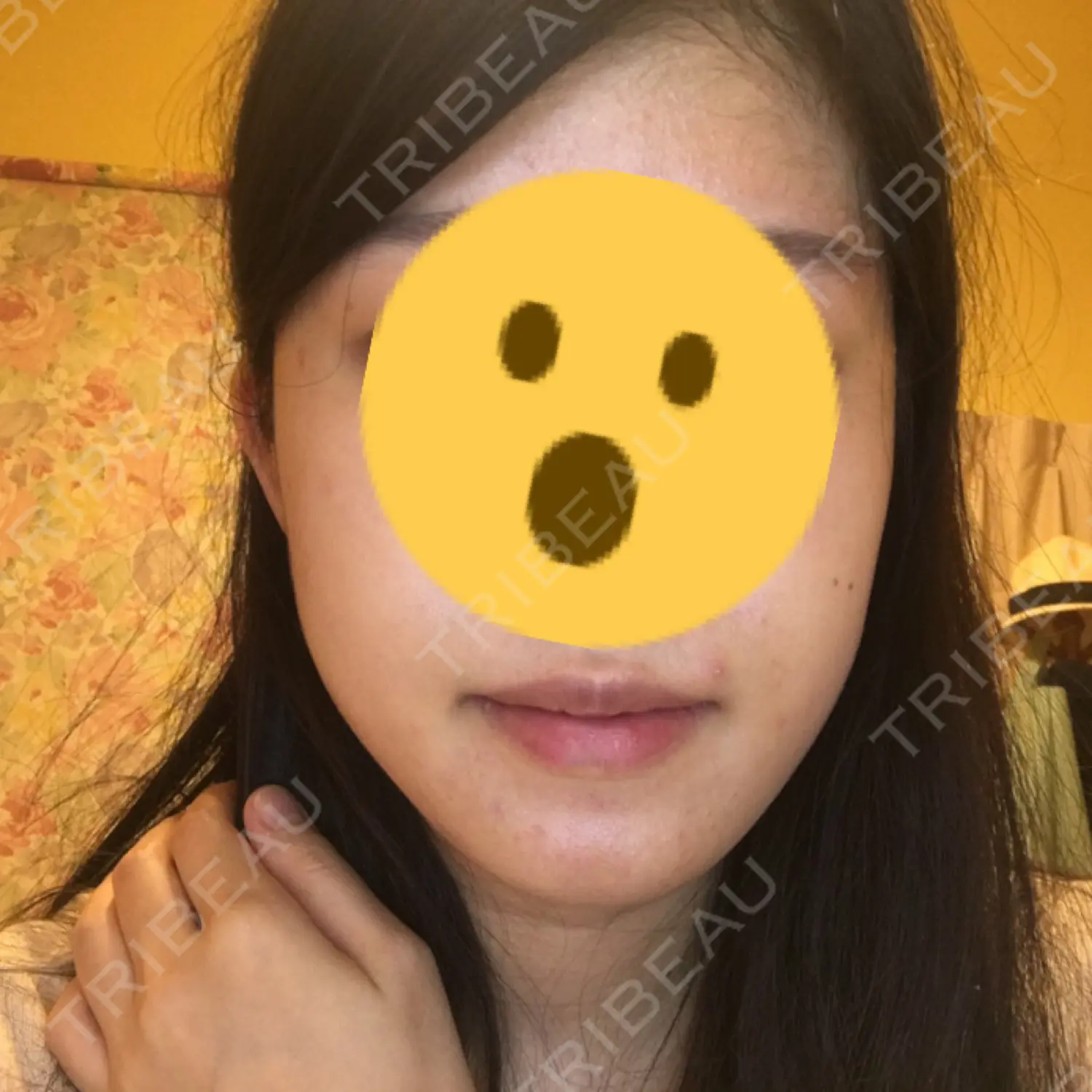 施術前の写真