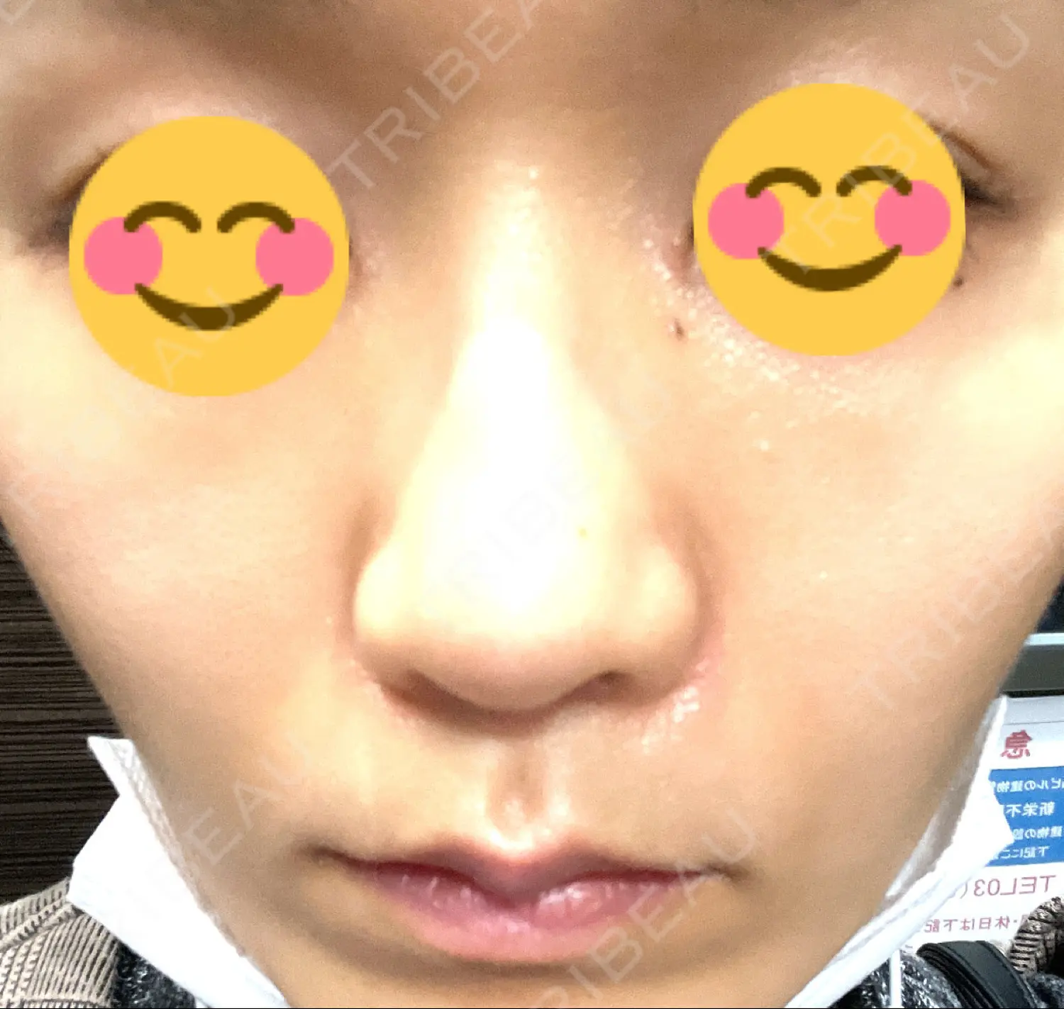 施術前の写真