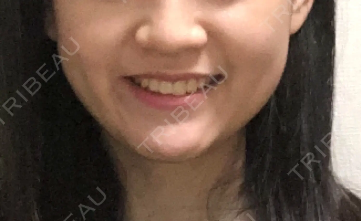 施術前の写真