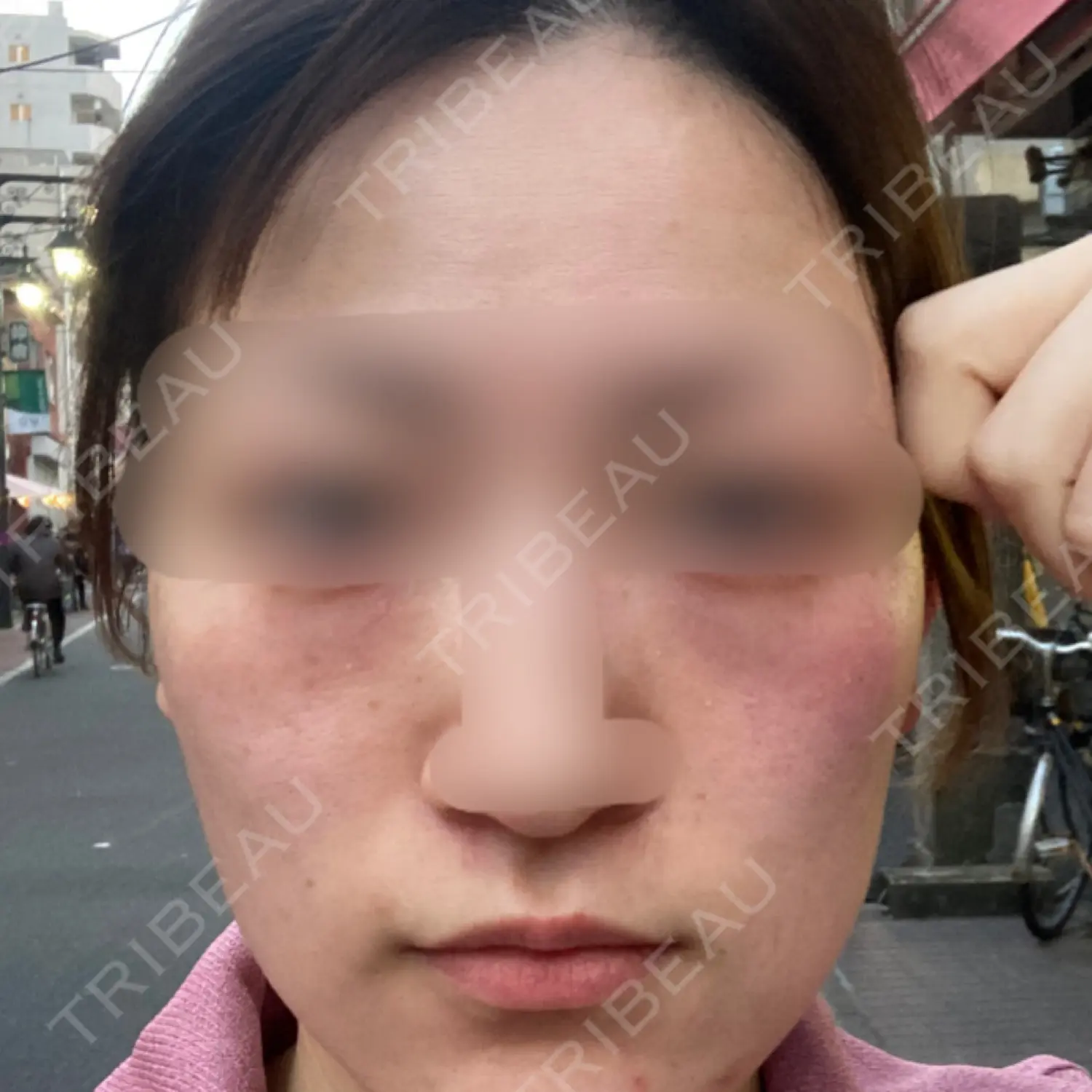 施術前の写真