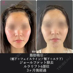 90 days after image