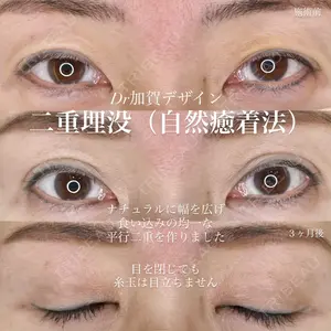 90 days after image