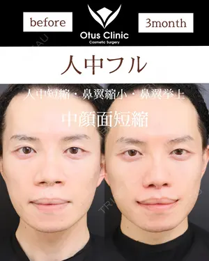 90 days after image