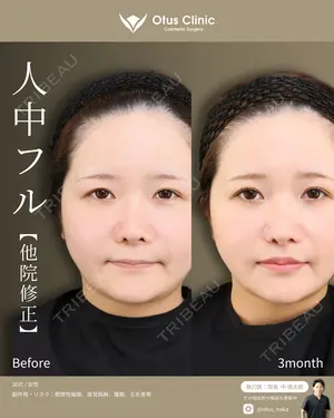 90 days after image