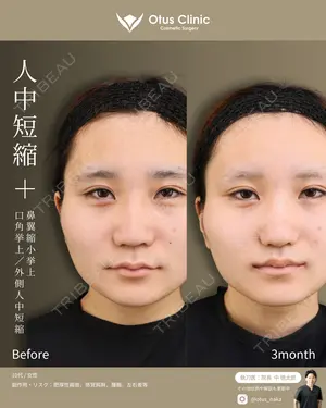 90 days after image