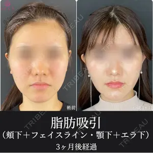 90 days after image