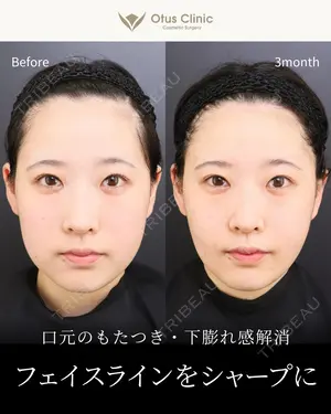 90 days after image