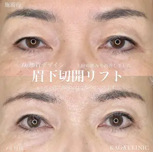before image